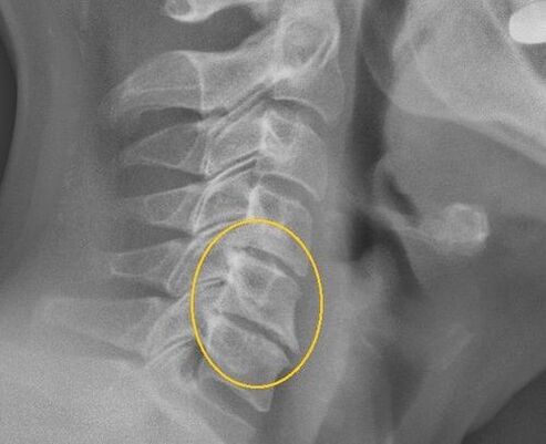 Ostéochondrose de la colonne cervicale sur une rayon x