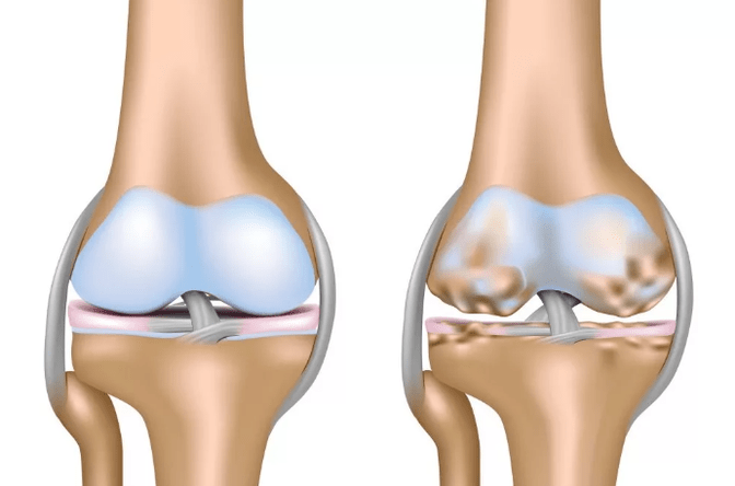 Arthrose déformant de l'articulation du genou
