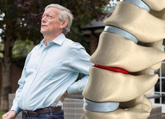 L'ostéochondrose affecte les disques intervertébraux et provoque des maux de dos