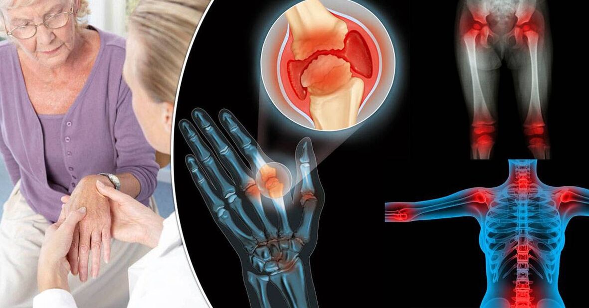 qu'est-ce que l'arthrose